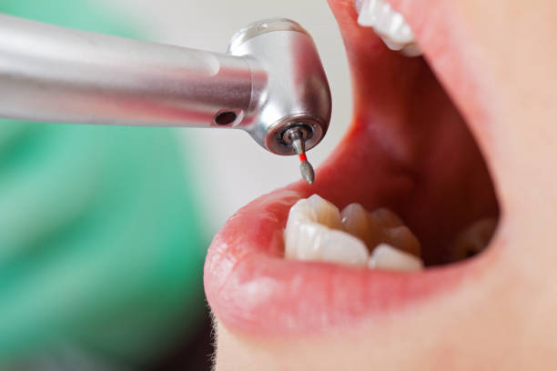 Best Knocked-Out Tooth (Avulsed Tooth) Treatment in Ellisburg, NJ